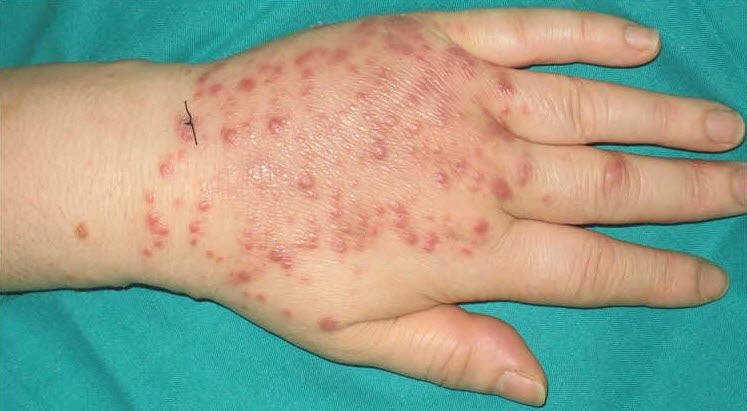 Mycobacteriosis Lesions